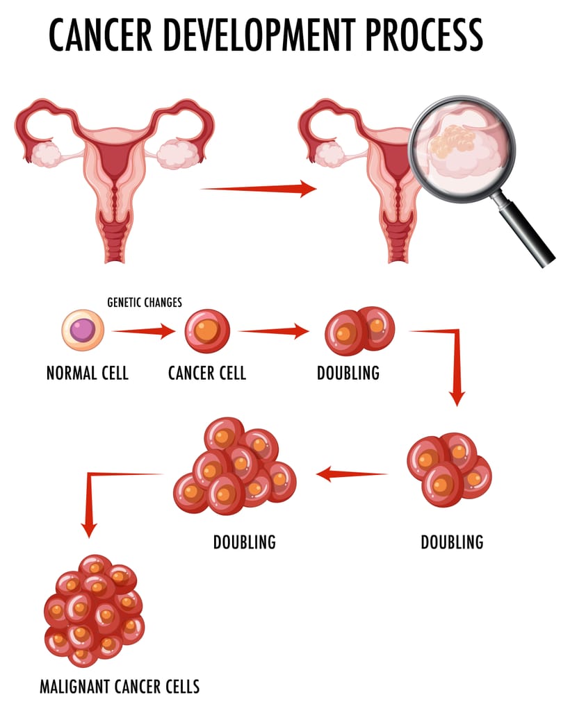 多囊卵巢綜合征(PCOS)